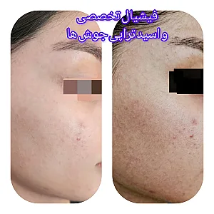 پاکسازی و جوانسازی پوست و زیبایی لیلا