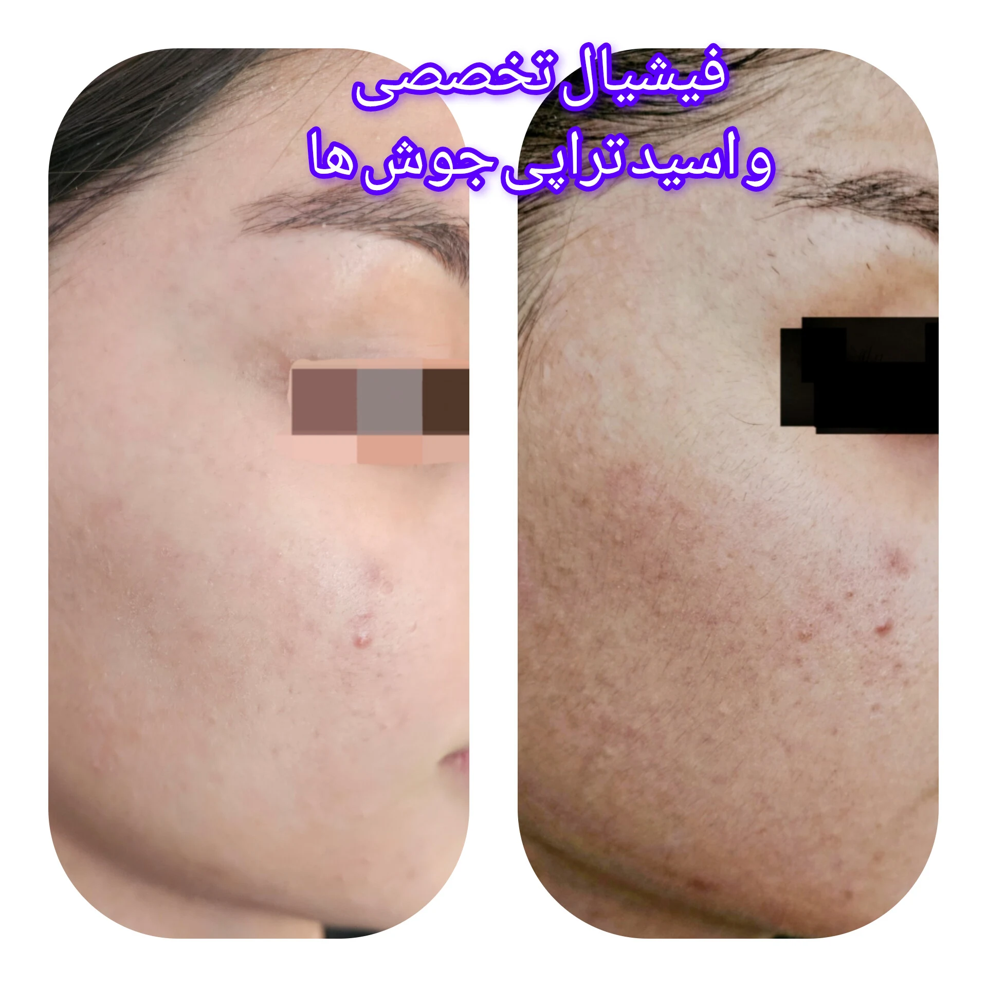 پاکسازی و جوانسازی پوست و زیبایی لیلا