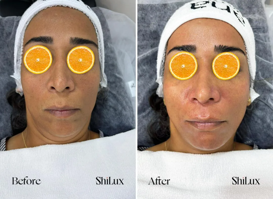 خدمات تخصصی پاکسازی پوست و فیشال شیلوکس - تصویر 4