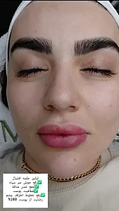 خدمات تخصصی فشیال صورت ساره