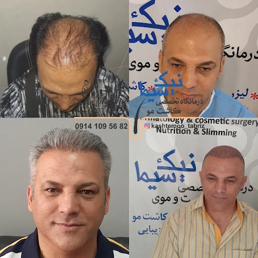 کلینیک تخصصی پوست و مو نیک سیما (کاشت مو) - تصویر 13