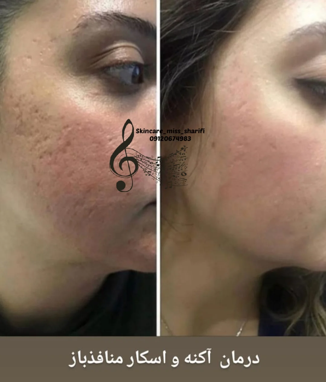 فیشال درمانی و پاکسازی تخصصی قم - کلینیک پوست و زیبایی در قم - تصویر 2