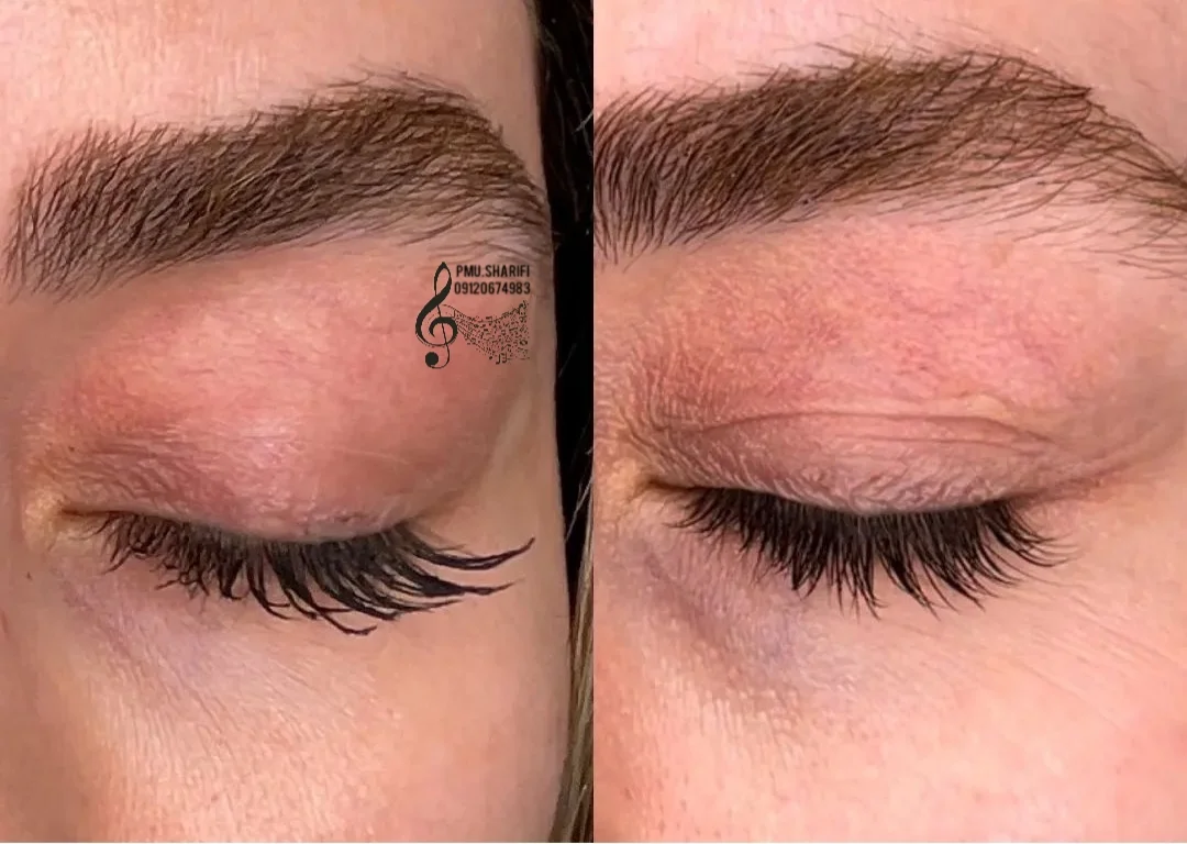 فیشال درمانی و پاکسازی تخصصی قم - کلینیک پوست و زیبایی در قم - تصویر 4