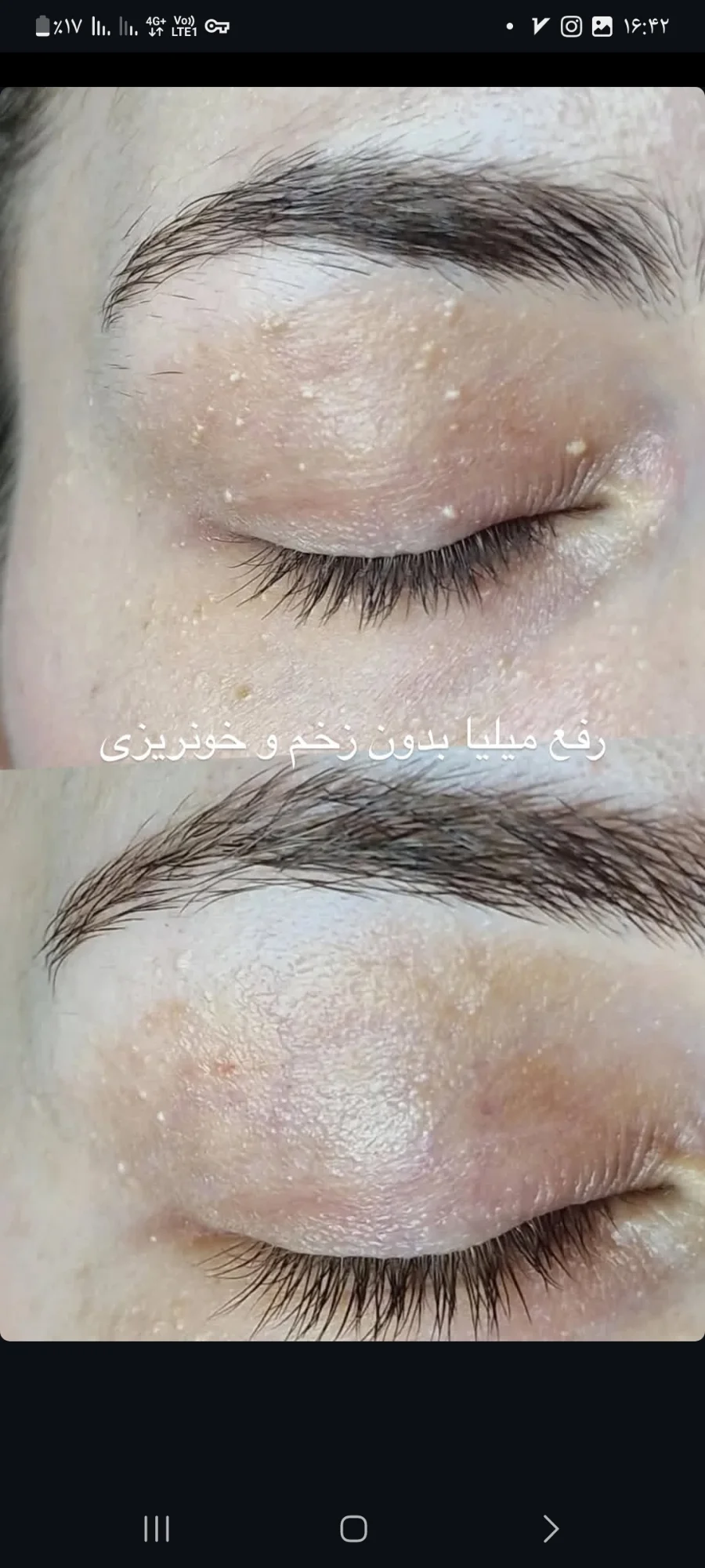فیشال درمانی و پاکسازی تخصصی قم - کلینیک پوست و زیبایی در قم - تصویر 6
