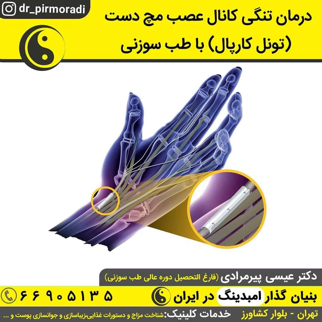 مطب طب سوزنی - تصویر 3