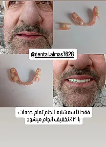 کامپوزیت لایرینگ و دندانسازی دکتر صفری