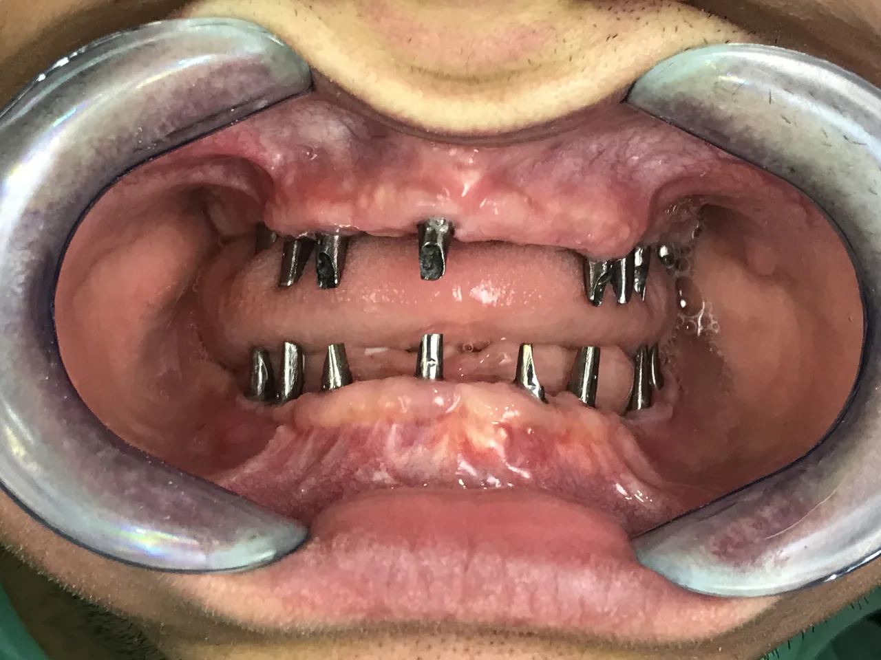 دندانپزشکی دکتر علی ضیائی متخصص ایمپلنت - تصویر 2