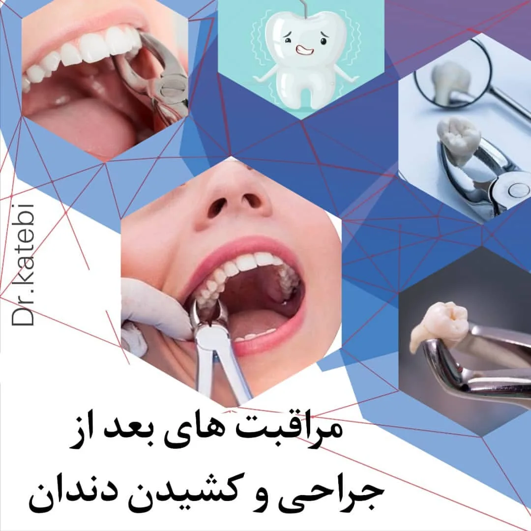 دندانپزشکی زیبایی و ایمپلنت دکتر آرش کاتبی - تصویر 4