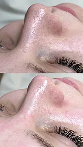 فشیال تخصصی و پاکسازی بیوتی تراپیس