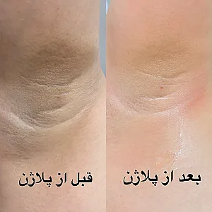 لیزر موی زائدهمراه روشن سازی پوست مژگان