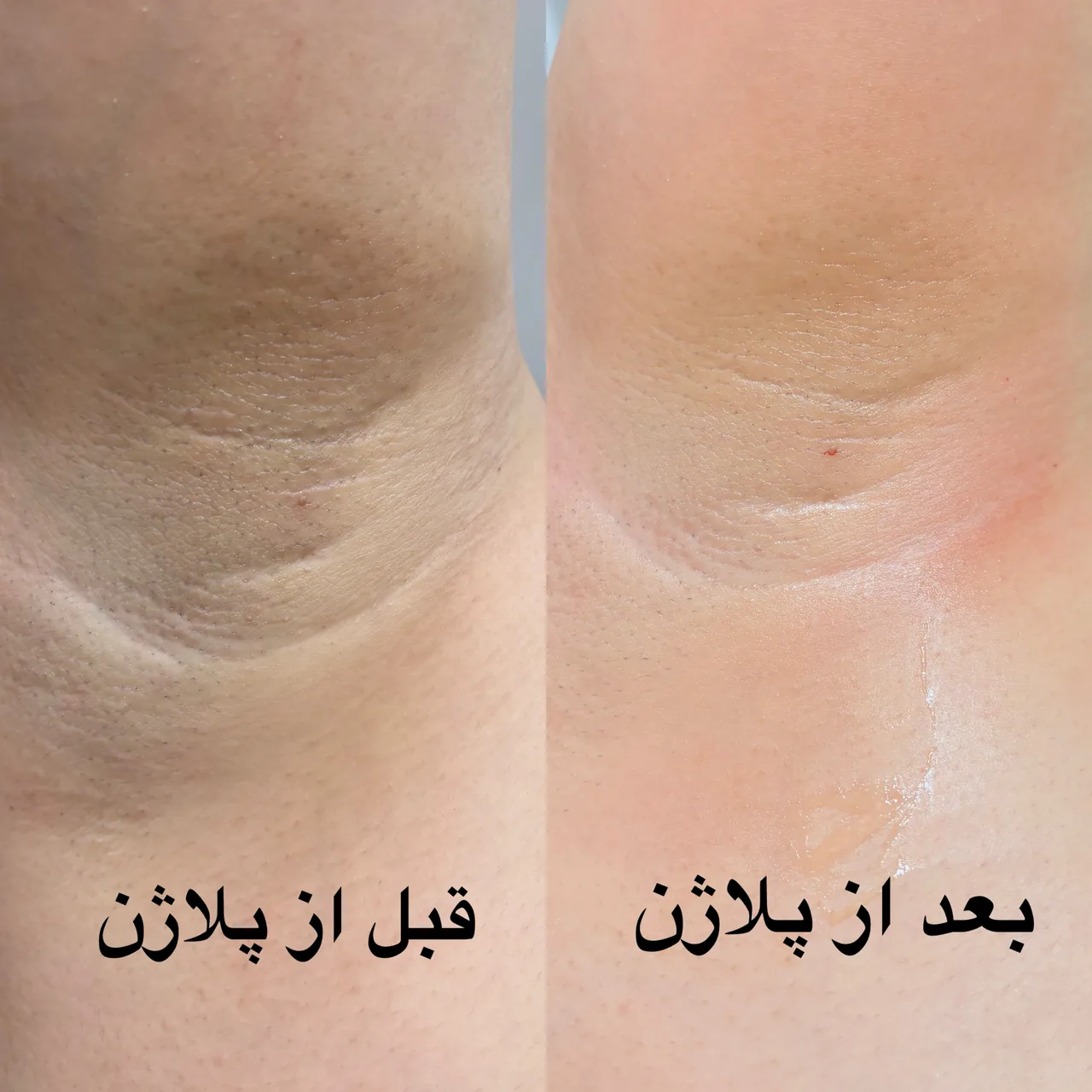 لیزر موی زائدهمراه روشن سازی پوست مژگان