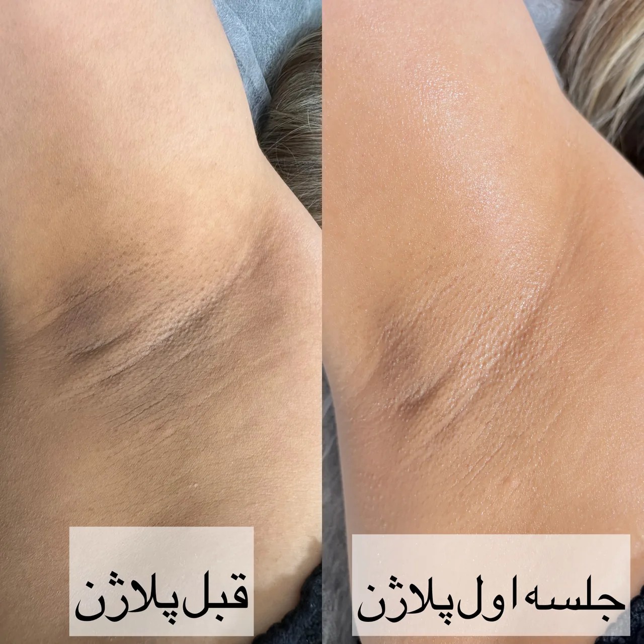 لیزر موی زائدهمراه روشن سازی پوست مژگان - تصویر 2