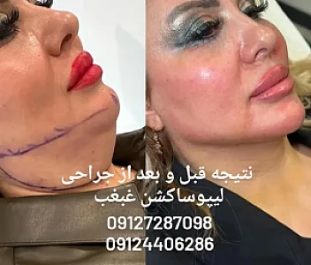 کاشت ابرو طبیعی
