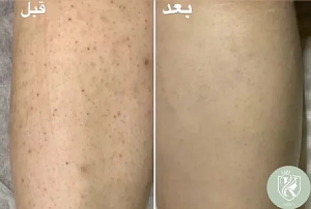 مرکزلیزر کارلیا(50درصد تخفیف جلسه اول)
