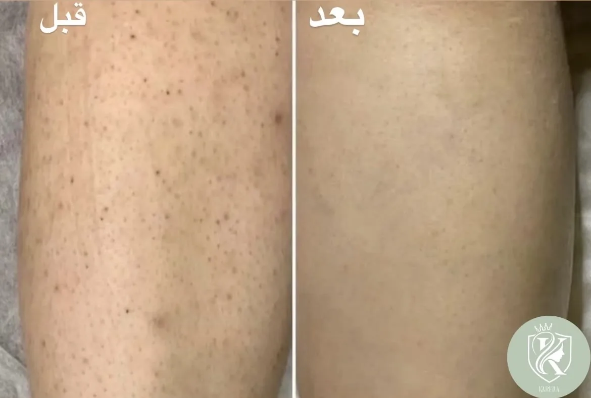 مرکزلیزر کارلیا(50درصد تخفیف جلسه اول)