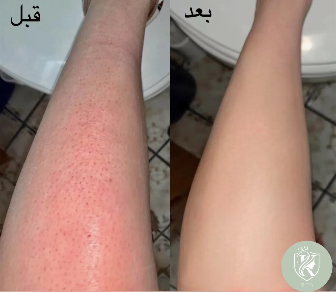 مرکزلیزر کارلیا(50درصد تخفیف جلسه اول) - تصویر 4