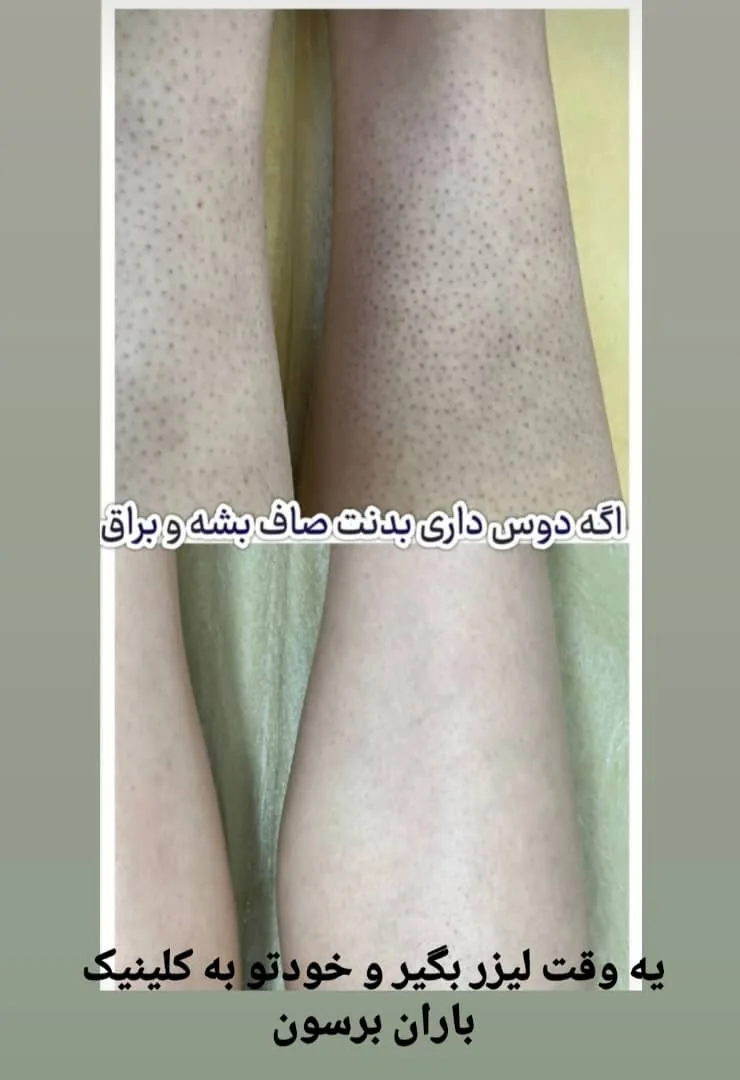 مرکز لیزر موهای زائد باران - تصویر 2