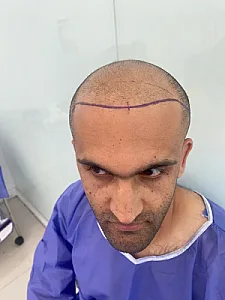 کلینیک کاشت مو و ابرو آزاد رستمی