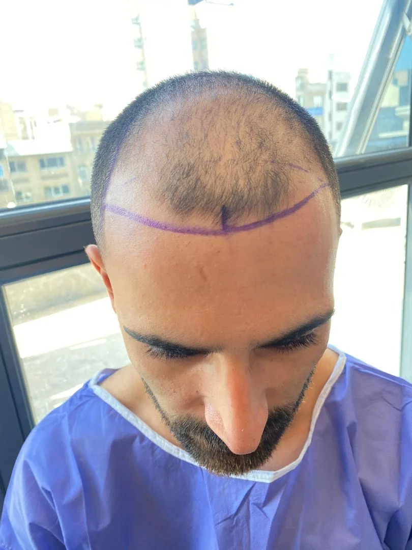 کلینیک کاشت مو و ابرو آزاد رستمی - تصویر 2
