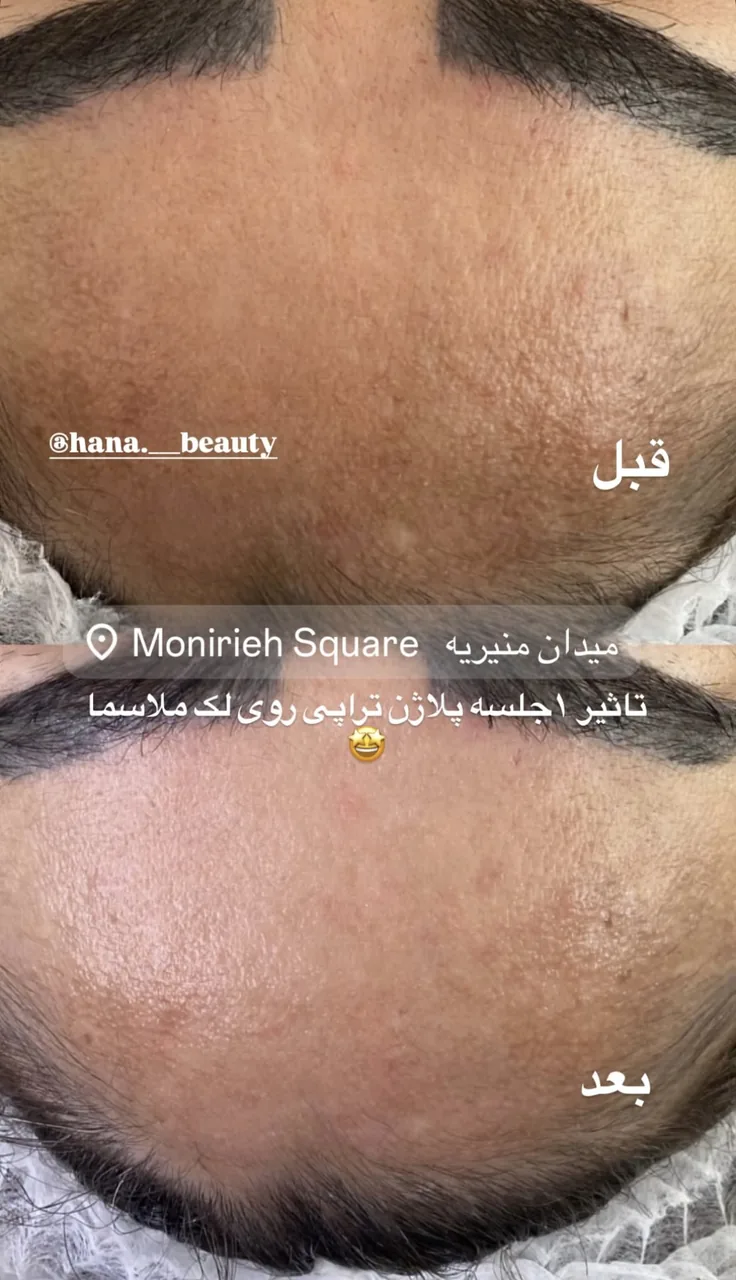 فیشال و پاکسازی تخصصی حنانه وقاری - تصویر 4