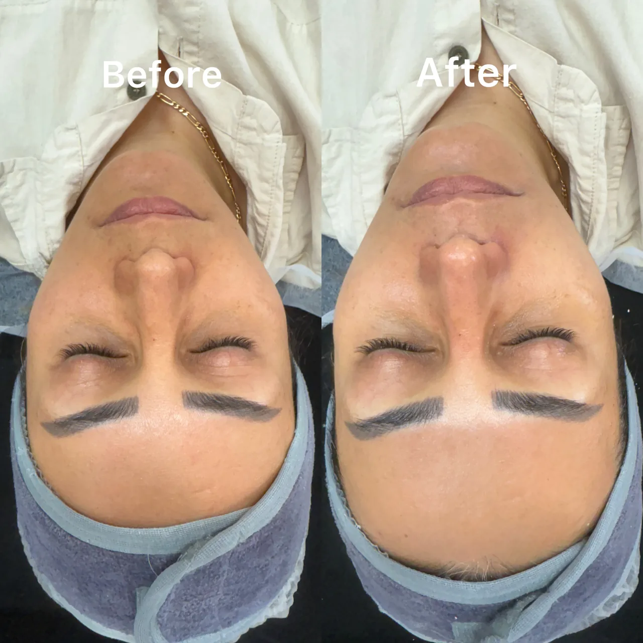 فشیال و پاکسازی پوست النازوید - تصویر 2