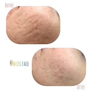 پاکسازی پوست بانوانmissFace
