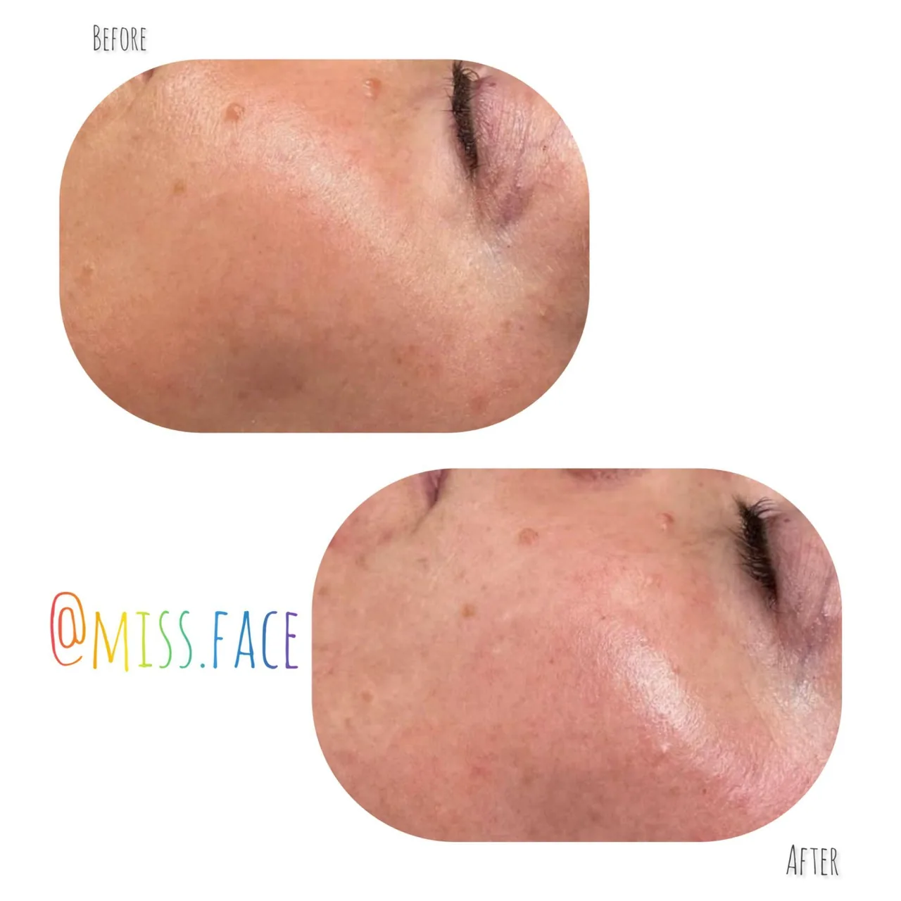 پاکسازی پوست بانوانmissFace - تصویر 3