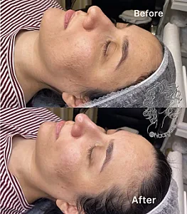 فیشال و  پاکسازی تخصصی پوست نرگس