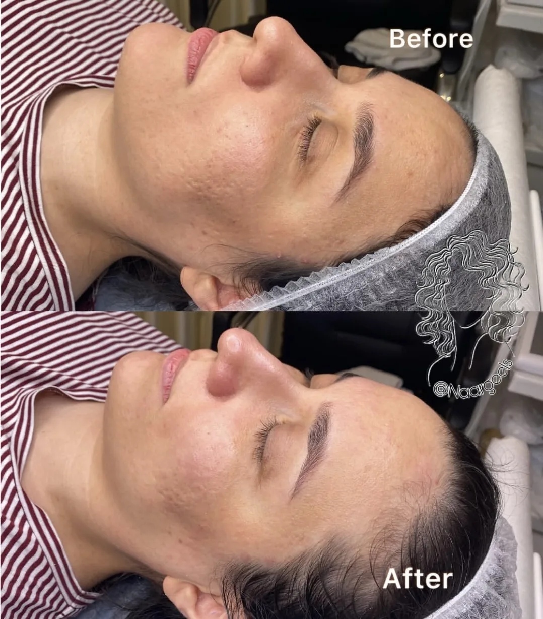 فیشال و  پاکسازی تخصصی پوست نرگس