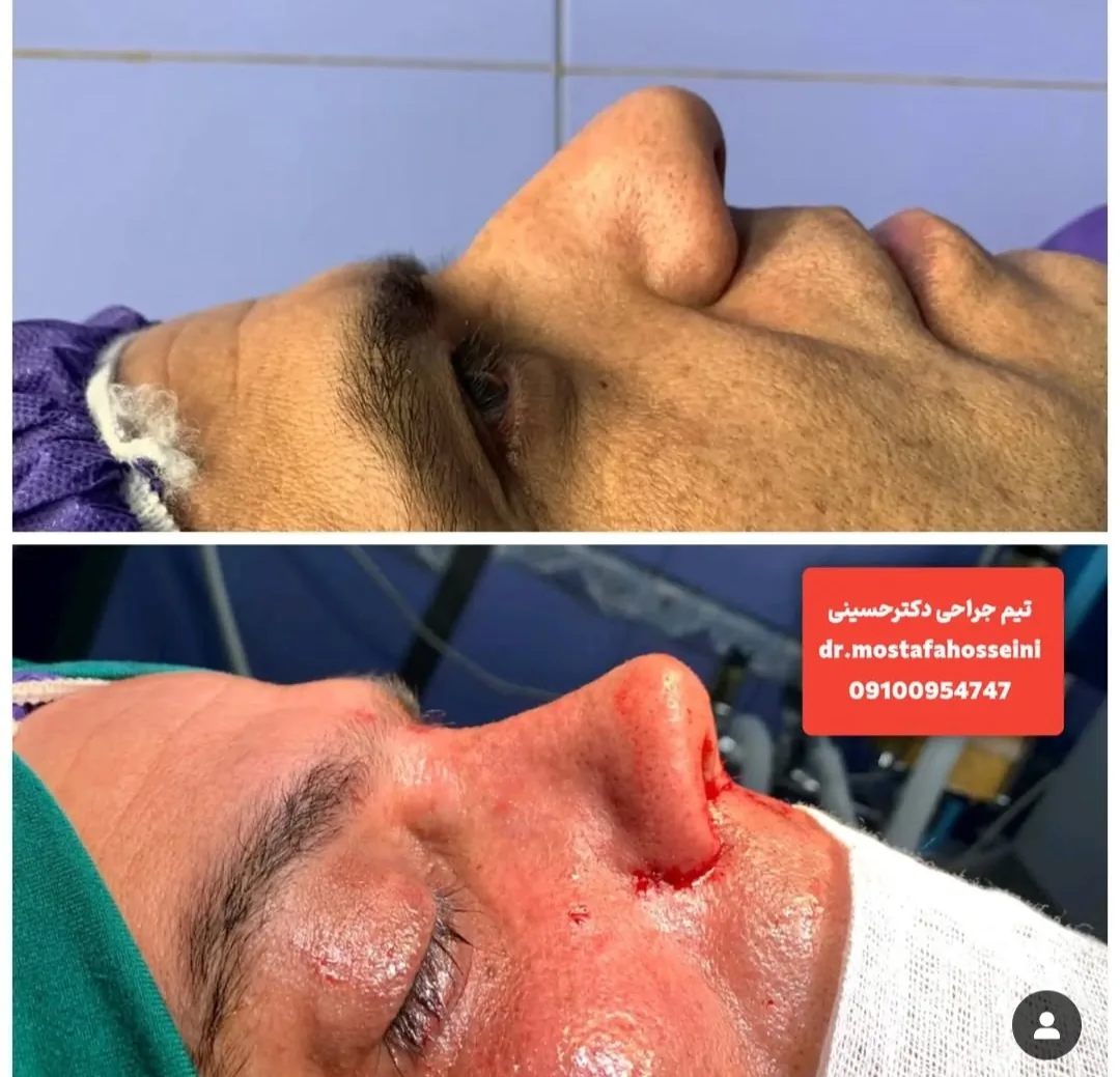 جراحی تخصصی بینی  گوشتی استخوانی - تصویر 3