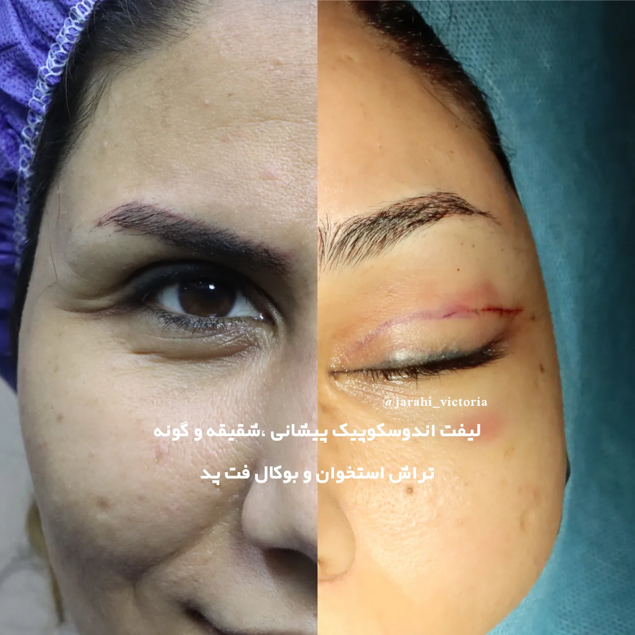 جراحی ویکتوریا صورت سینه شکم - تصویر 5