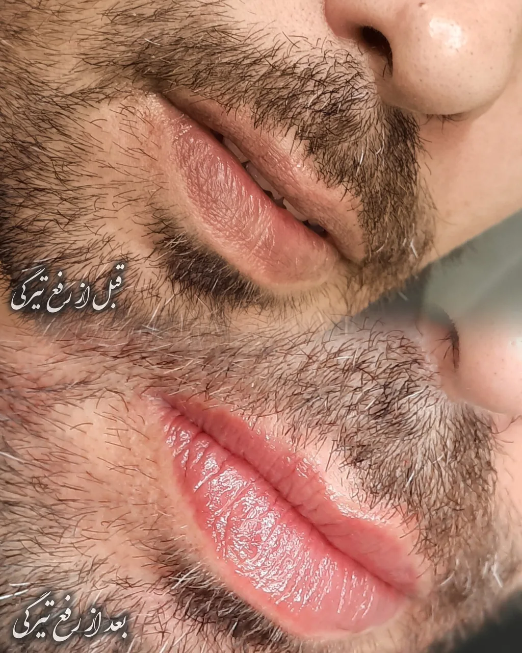 خدمات فوق تخصصی ریموو، شِید لب، بُن مژه - تصویر 3