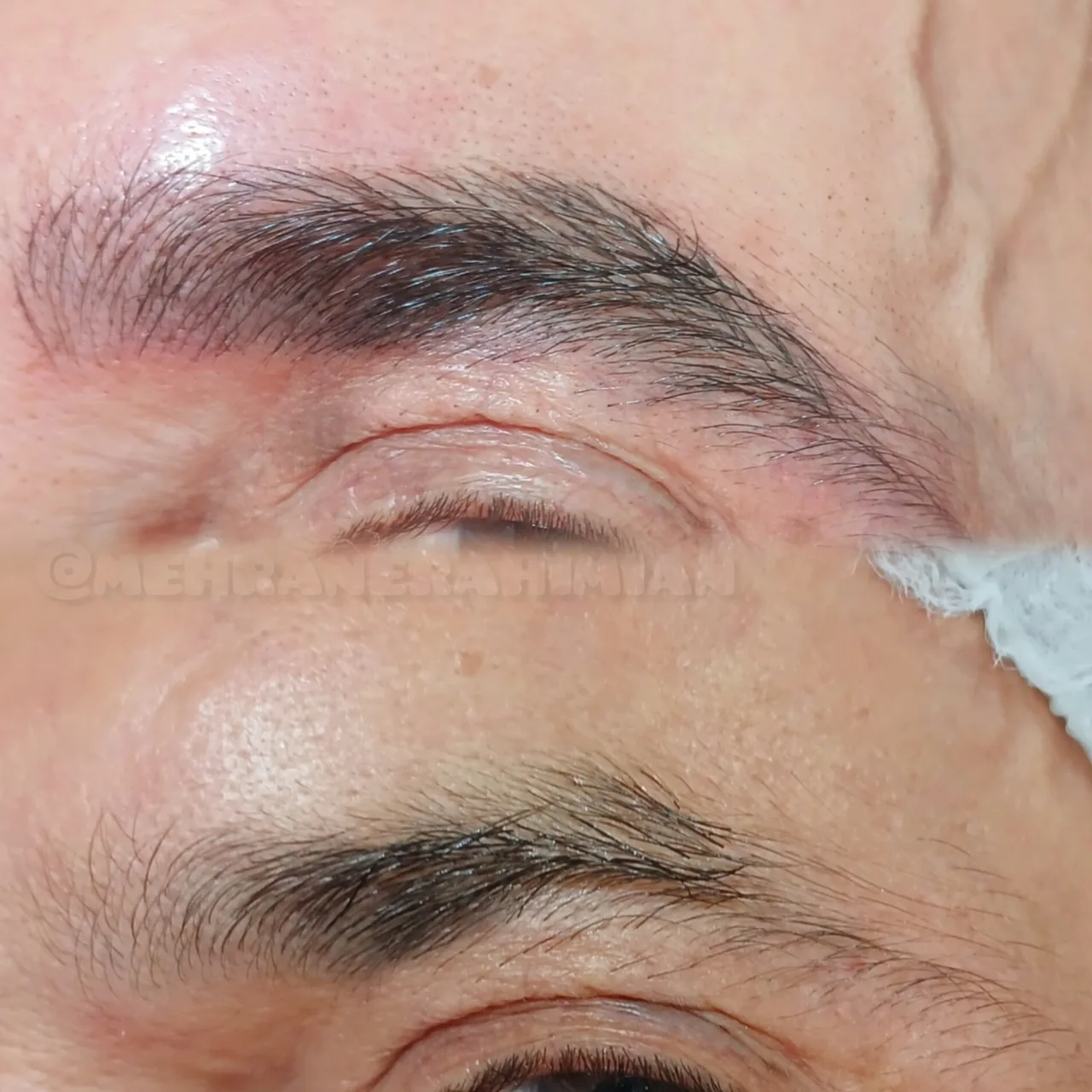 خدمات تخصصی میکروبلیدینگ ابرو - کلینیک پوست و زیبایی در تهران - تصویر 4
