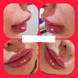 مرکز تزریق چربی و لیزر بدن شمس آباد