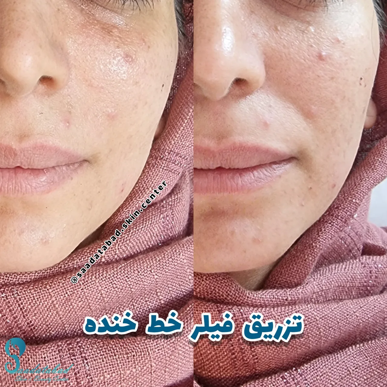 مرکز تخصصی لیزر و زیبایی سعادت آباد - تصویر 3