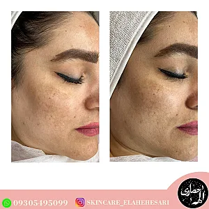 بیوتی تراپیست الهه حصاری