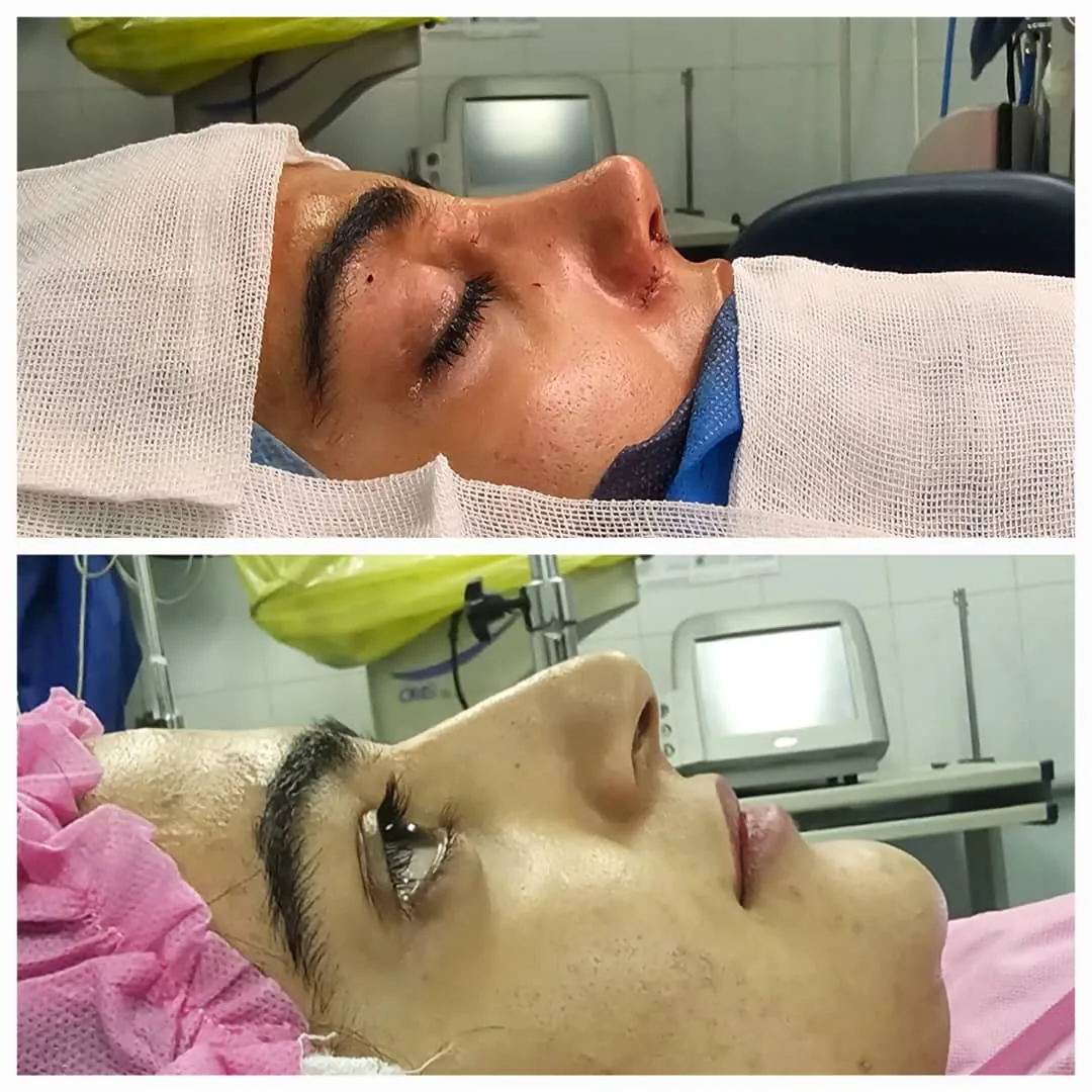 جراحی پلاستیک و زیبایی بینی صورت نئوفیس - تصویر 2