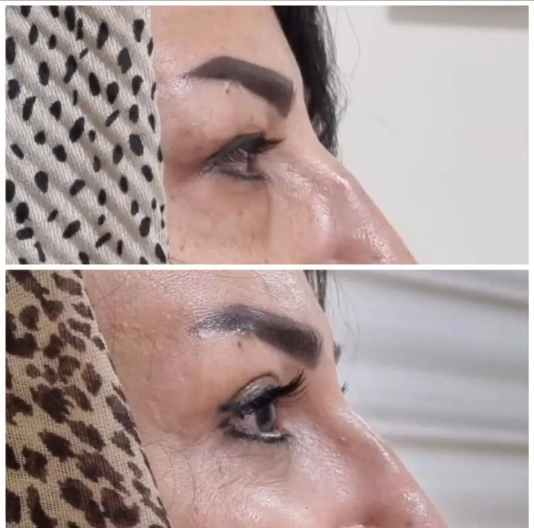 جراحی پلاستیک و زیبایی بینی صورت نئوفیس - تصویر 3