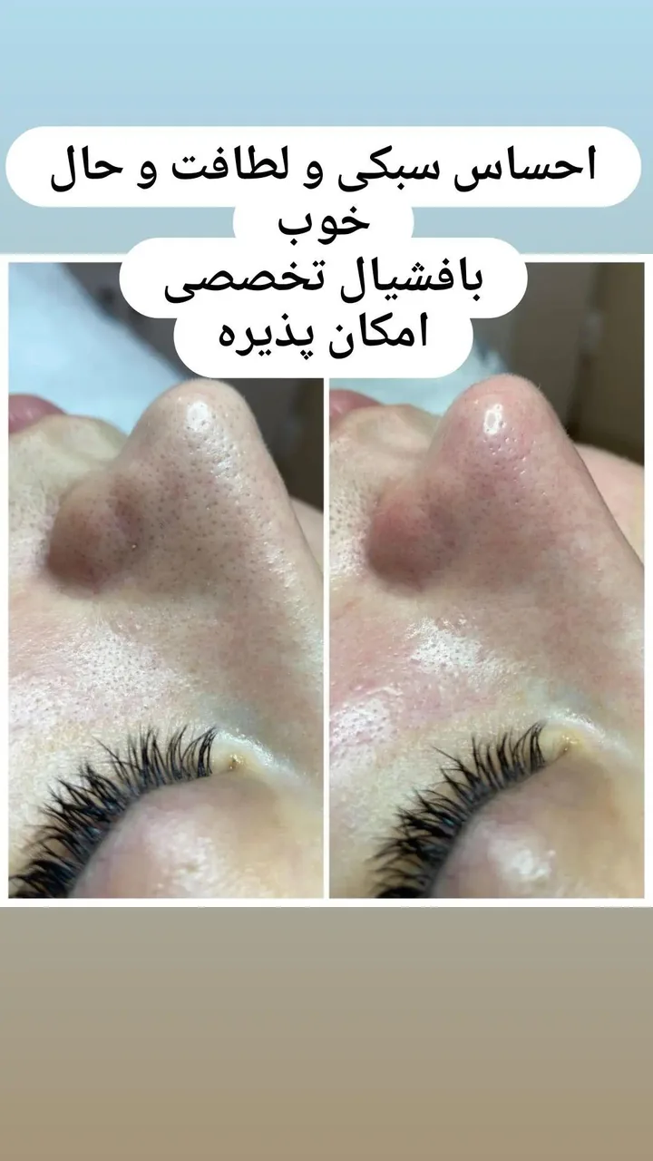 پاکسازی و فشیال تخصصی پوست فاطمه توکلی - تصویر 4