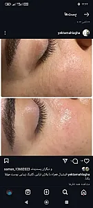 تزریق ژل و بوتاکس یکتا