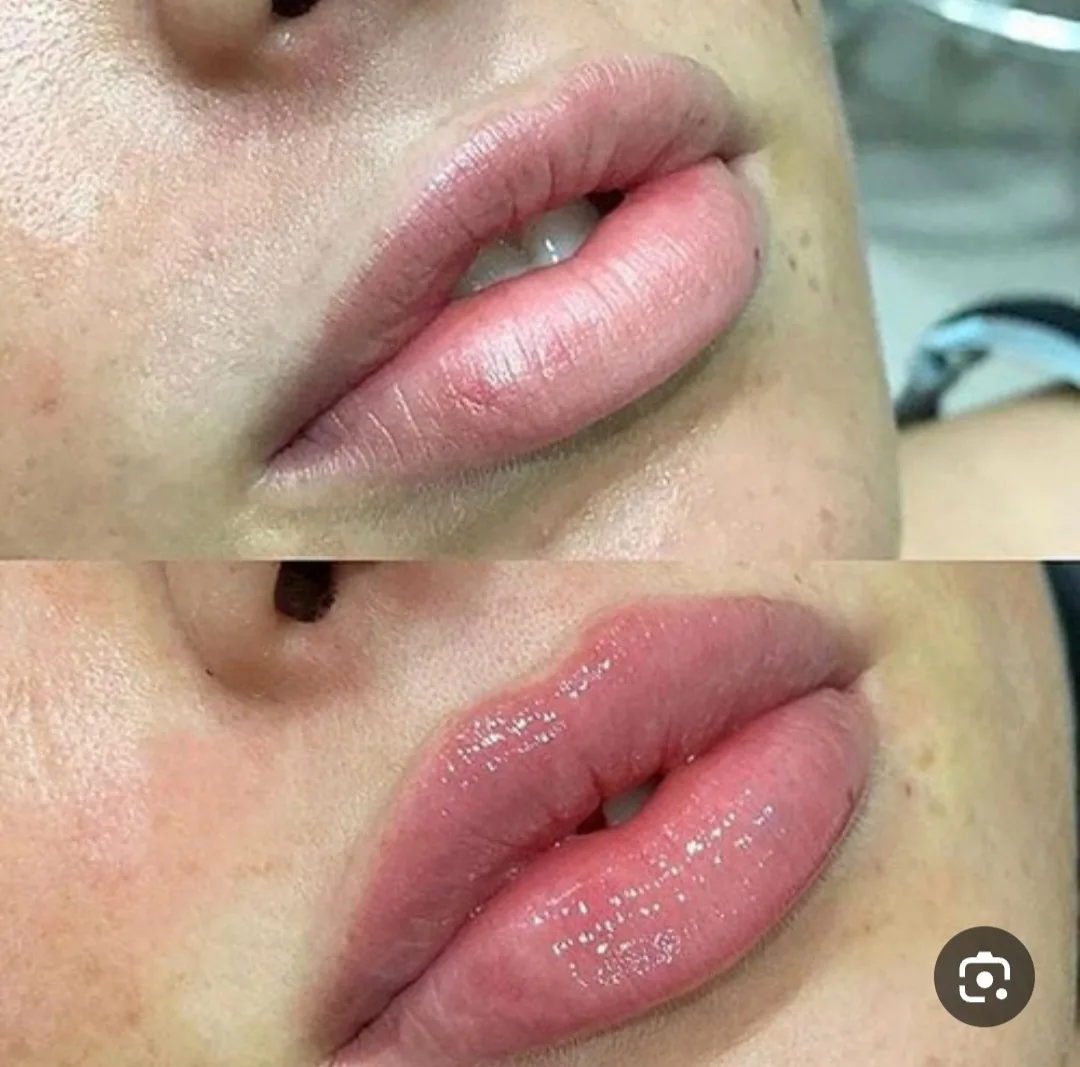 تزریق ژل و بوتاکس یکتا - تصویر 3