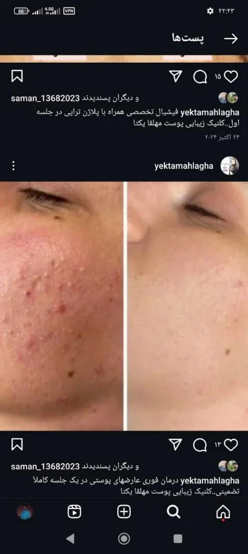 تزریق ژل و بوتاکس یکتا - تصویر 4