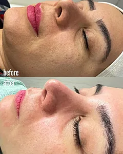 فیشال و پاکسازی پوست تخصصی بانوان نیلا