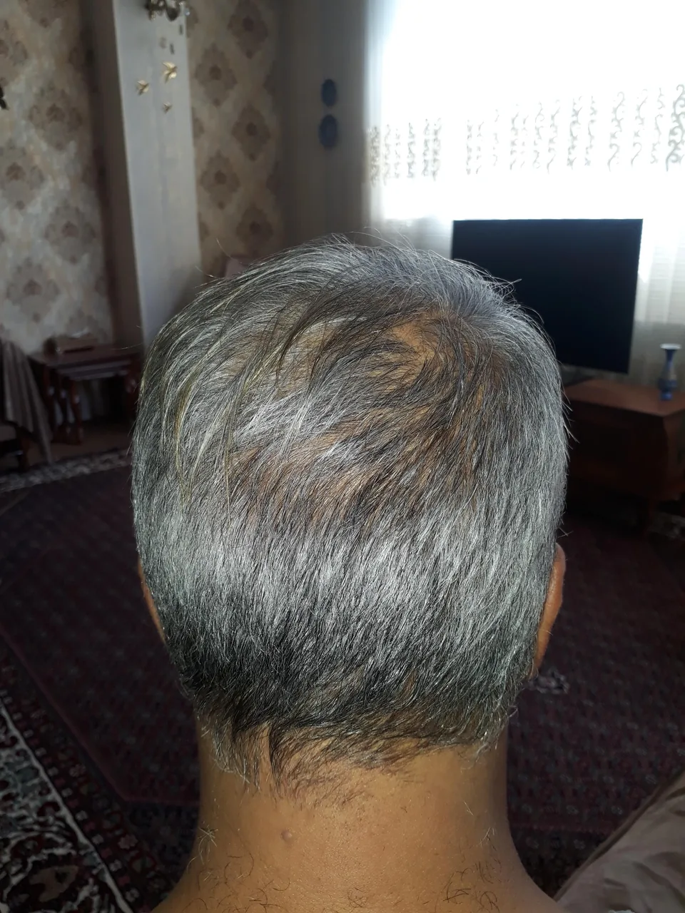 کلینیک کاشت مو ارم