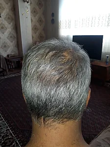 کلینیک کاشت مو ارم