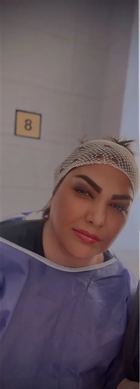 کاشت ابرو سلطانی متد پنج زاویه - تصویر 2