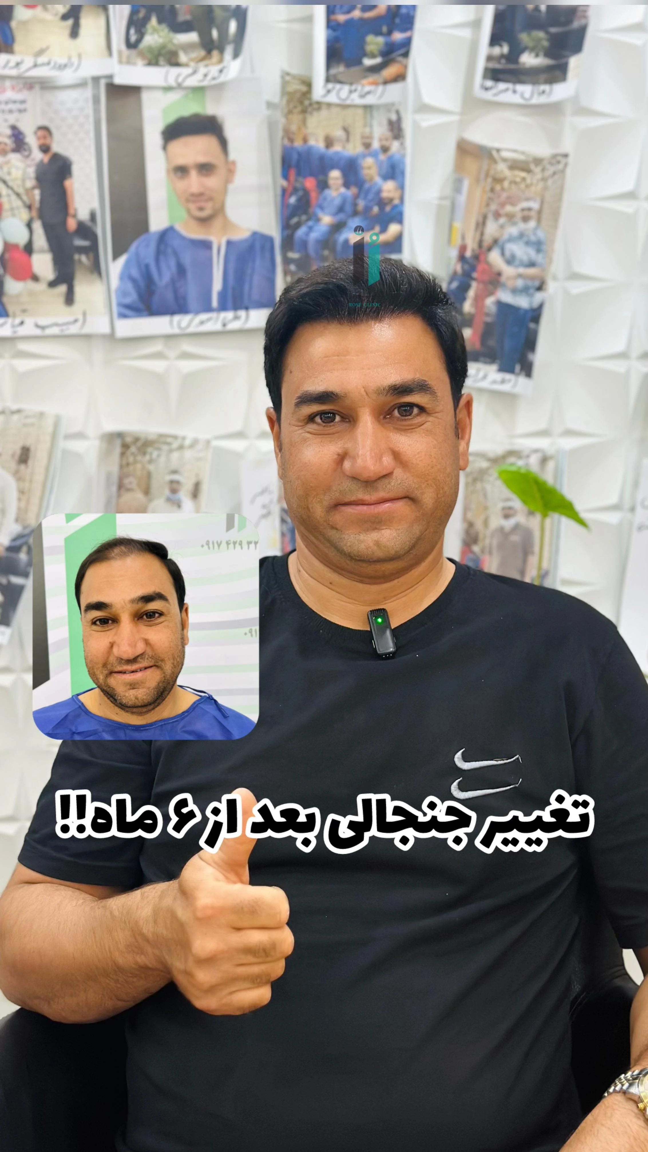 کاشت مو رز