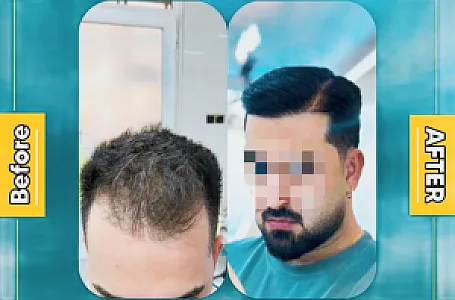 کیلینک کاشت مو