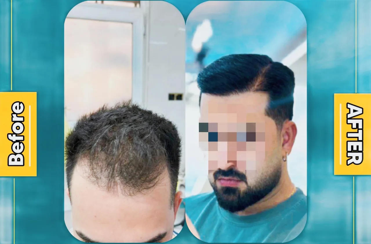 کیلینک کاشت مو