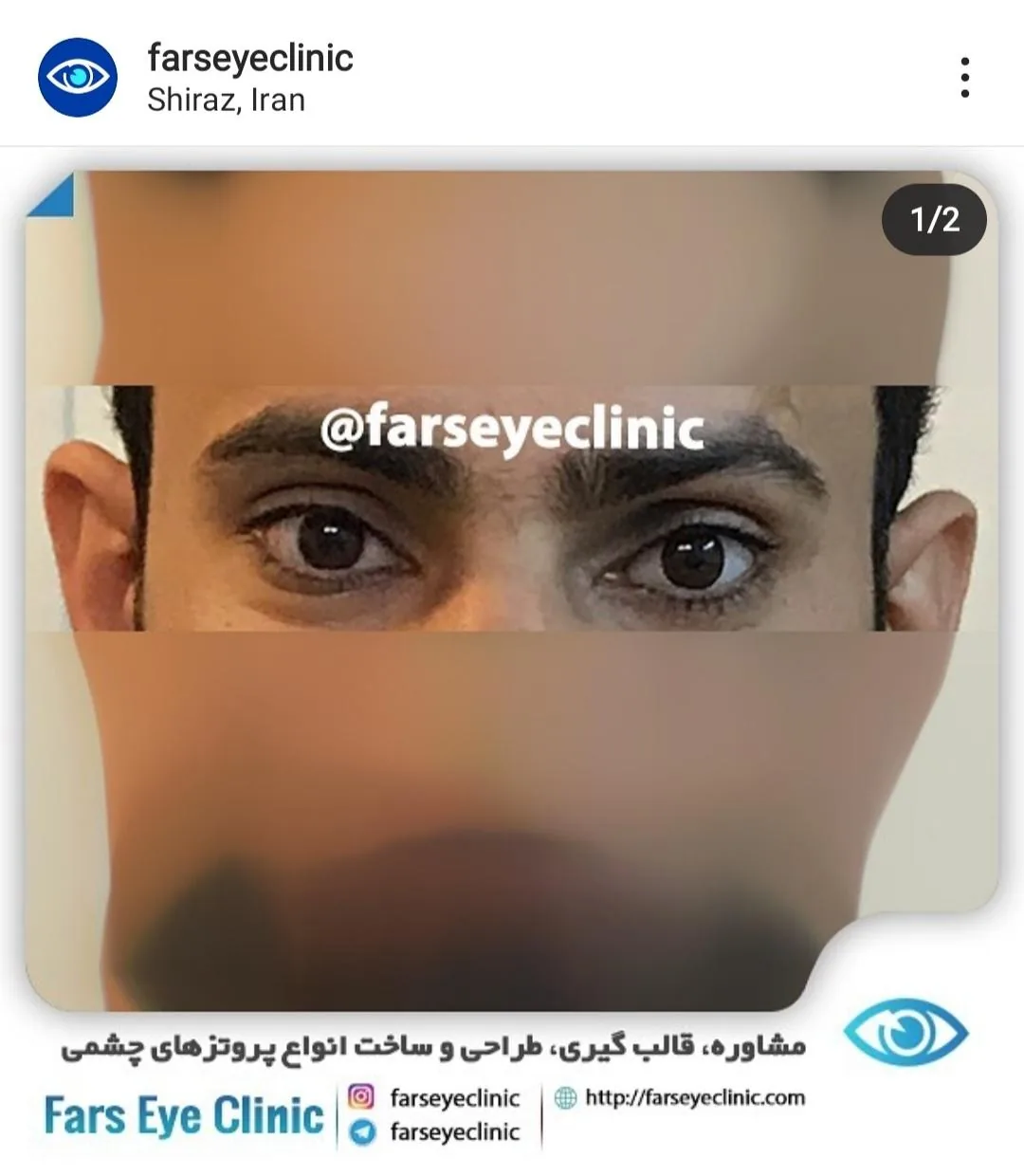 کلینیک ساخت چشم مصنوعی فارس - تصویر 3